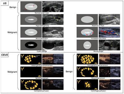 The diagnosis and management of small and indeterminate lymph nodes in papillary thyroid cancer: preoperatively and intraoperatively